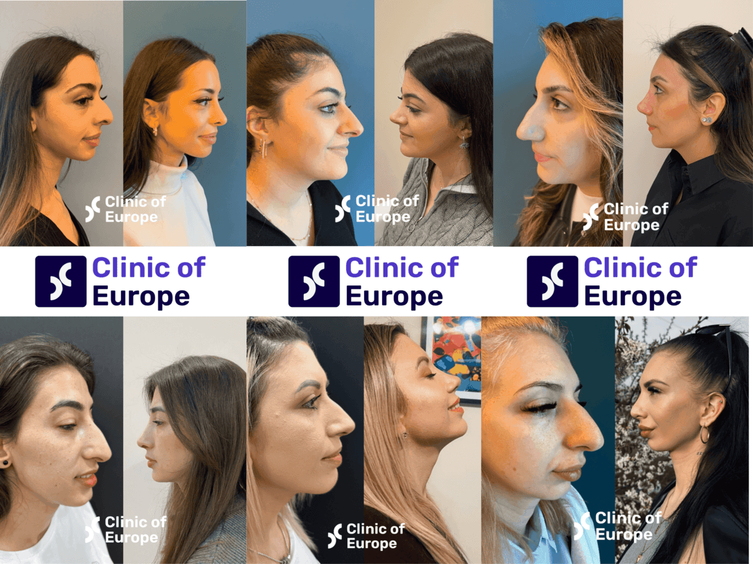 How to Choose a Top Rhinoplasty Clinic in Europe for Nasal Surgery